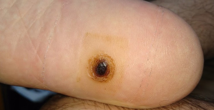 足裏イボを一週間ほど木酢液で治療をしていたら、カサブタみたいになって剥がれそうだったので、ピンセットで剥がしてやったの画像