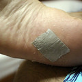ダクトテープでウイルス性いぼ（尋常性疣贅）を治療した一か月の記録の画像