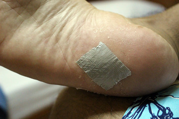 ダクトテープでウイルス性いぼ（尋常性疣贅）を治療した一か月の記録の画像